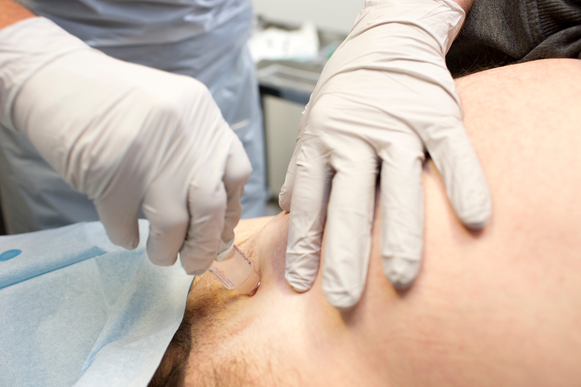 suprapubische katheter