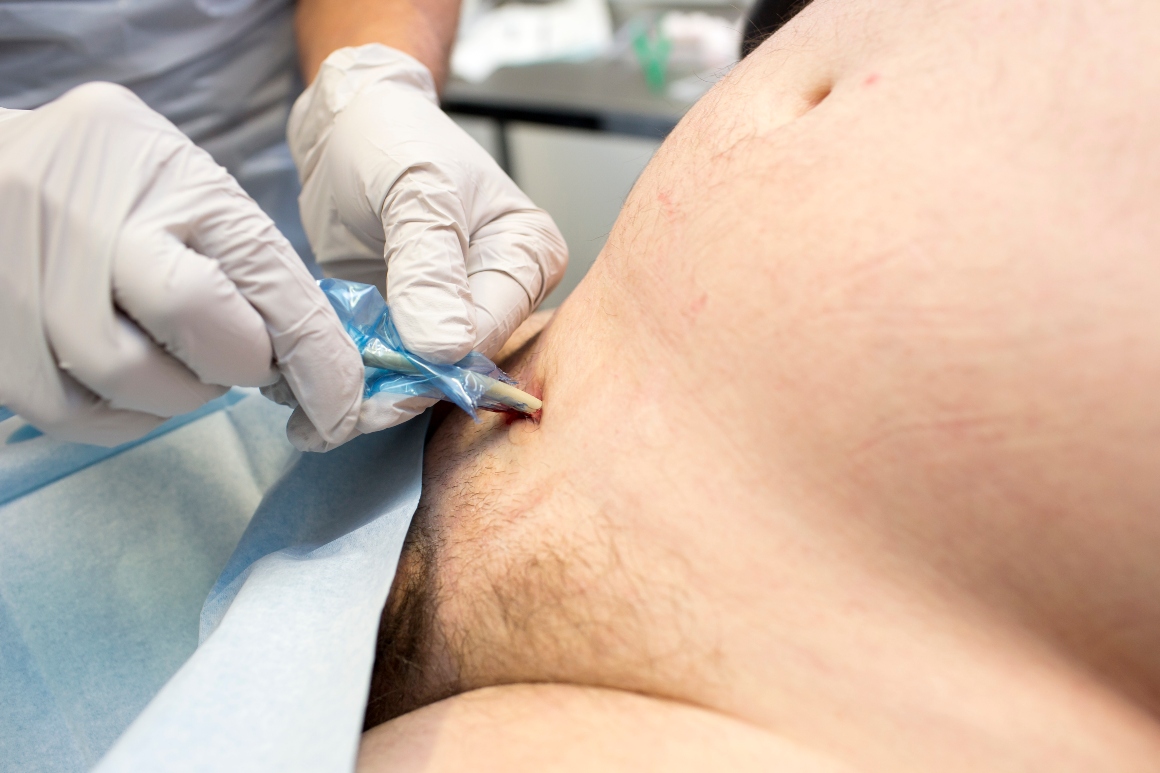 suprapubische katheter