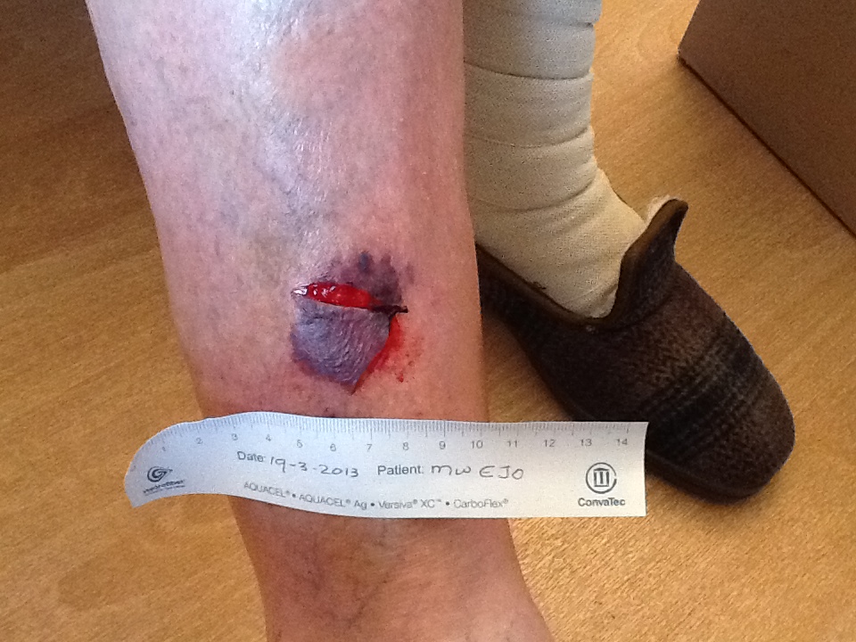 Skin tear op been met meetlint eronder