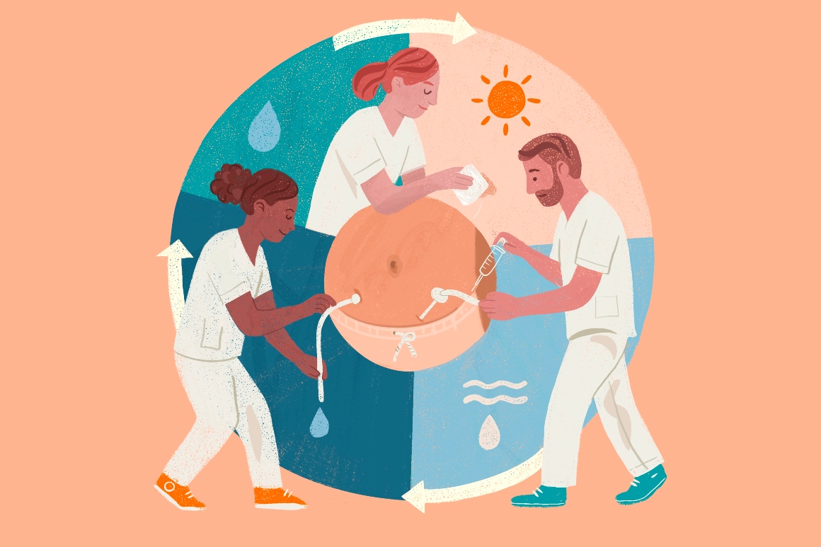 Illustratie verzorging percutane sondes