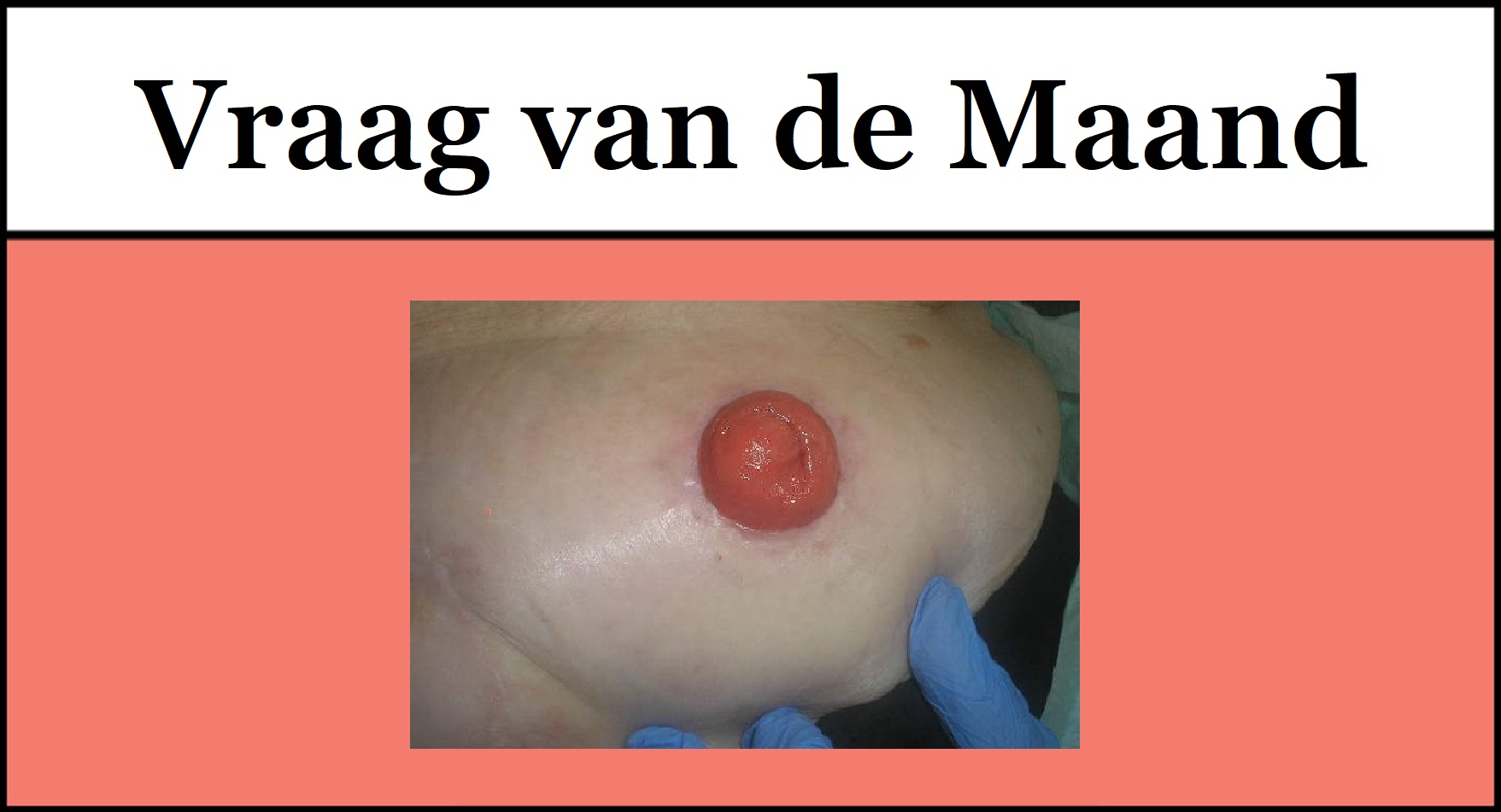 Foto van een stoma