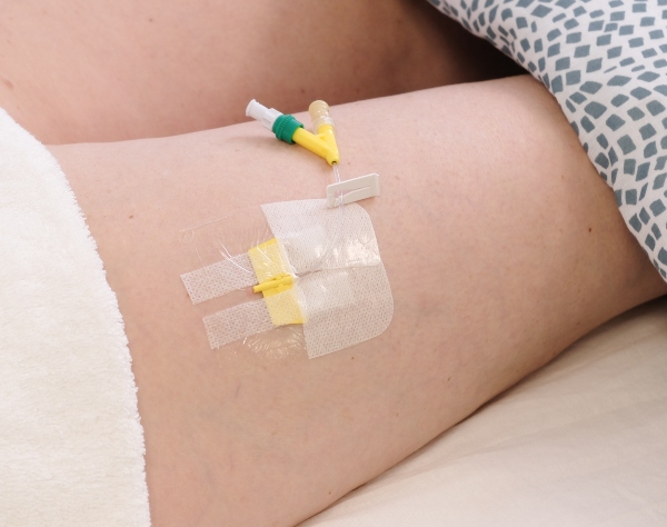 Subcutane canule voor palliatieve sedatie ingebracht in bovenbeen cliënt